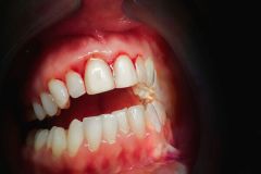 Mouth with bleeding gums on a dark background.