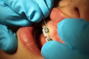 Como usar el hilo dental correctamente - Álvaro y Franco. Clínica dental en  Torrelodones