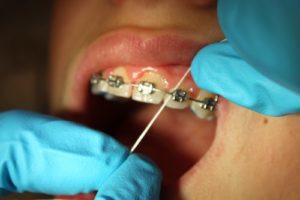 Como usar el hilo dental correctamente - Álvaro y Franco. Clínica